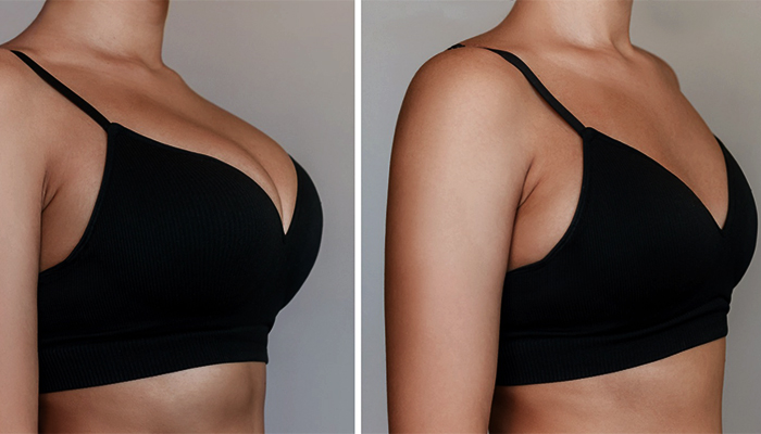 Breast Reduction Prices in Turkey 2023 Breast Reduction Prices in Turkey 2023