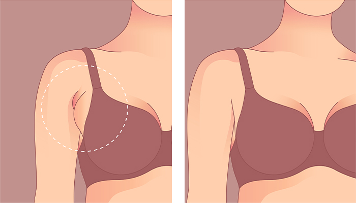 Breast Reduction Prices in Turkey 2023 Breast Reduction Prices in Turkey 2023