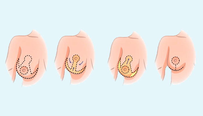 Breast Reduction Prices in Turkey 2023 Breast Reduction Prices in Turkey 2023