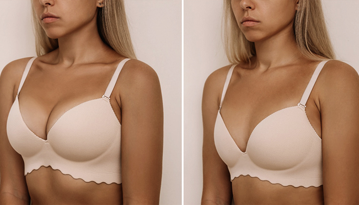 Breast Reduction Prices in Turkey 2023 Breast Reduction Prices in Turkey 2023