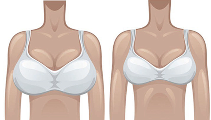 Breast Reduction Prices in Turkey 2023 Breast Reduction Prices in Turkey 2023