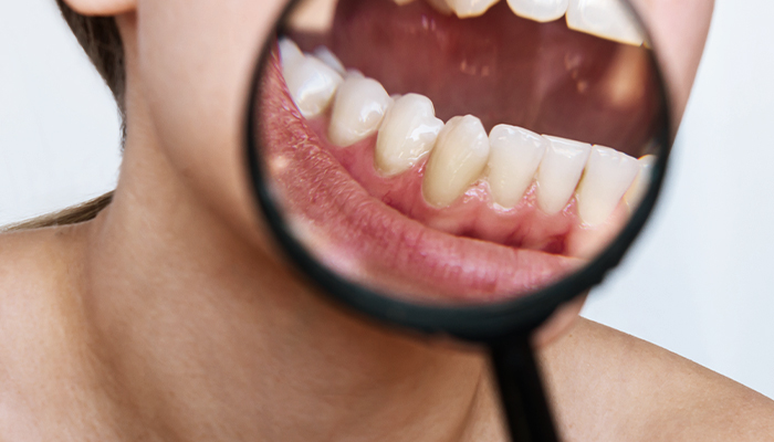 Gum Disease Treatment Prices in Turkey 2023 Gum Disease Treatment Prices in Turkey 2023