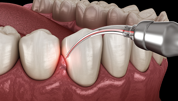 Gum Disease Treatment Prices in Turkey 2023 Gum Disease Treatment Prices in Turkey 2023