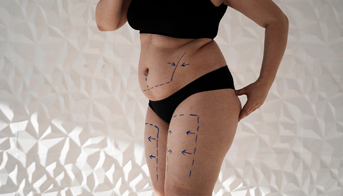 Liposuction Prices in Turkey 2023 Liposuction Prices in Turkey 2023