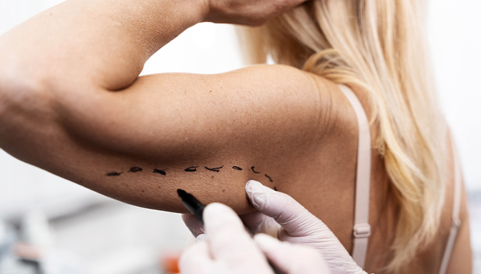 Liposuction Prices in Turkey 2023 Liposuction Prices in Turkey 2023