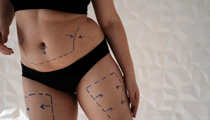 Liposuction Prices in Turkey 2023 Liposuction Prices in Turkey 2023