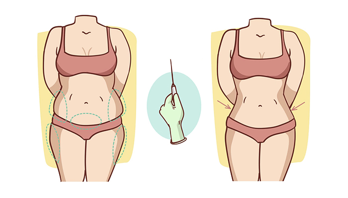 Liposuction Prices in Turkey 2023 Liposuction Prices in Turkey 2023