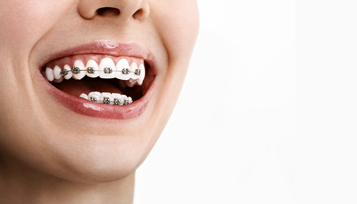 Dental Braces Prices in Turkey 2023 Dental Braces Prices in Turkey 2023
