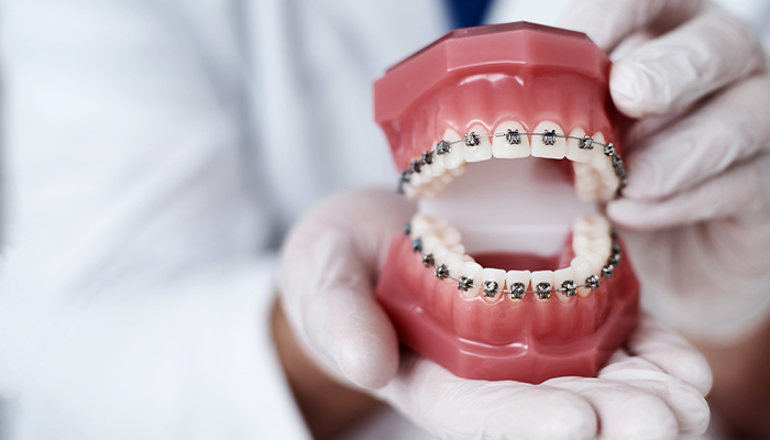 Dental Braces Prices in Turkey 2023 Dental Braces Prices in Turkey 2023