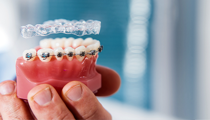 Dental Braces Prices in Turkey 2023 Dental Braces Prices in Turkey 2023