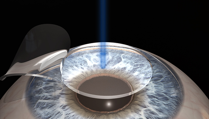 Laser Eye Surgery (Laser Vision Correction) Prices in Turkey 2024 Laser Eye Surgery (Laser Vision Correction) Prices in Turkey 2024