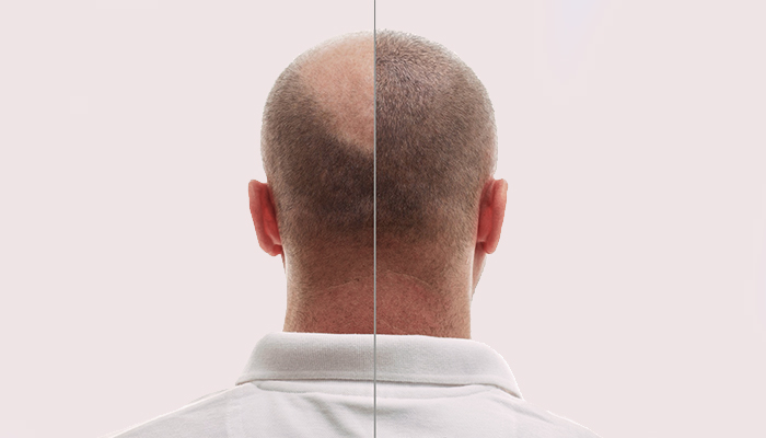 Hair Transplant Prices in Turkey 2024 Hair Transplant Prices in Turkey 2024