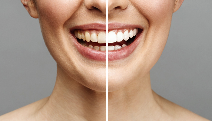 Teeth Whitening Prices in Turkey 2024