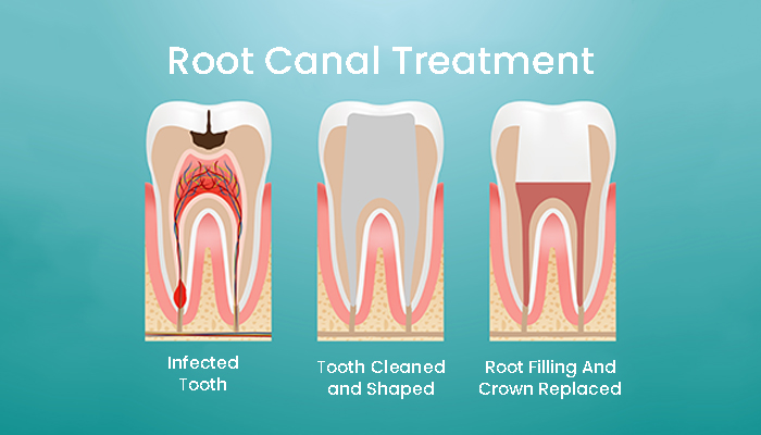 Root Canal Treatment Prices in Turkey 2023 Root Canal Treatment Prices in Turkey 2023