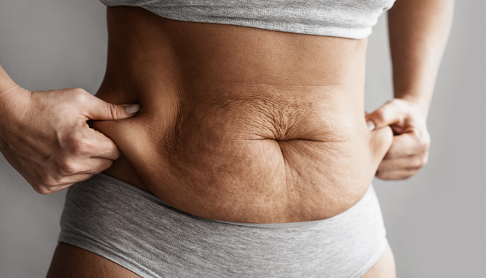 Tummy Tuck Prices in Turkey 2023 Tummy Tuck Prices in Turkey 2023