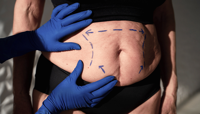 Tummy Tuck Prices in Turkey 2023 Tummy Tuck Prices in Turkey 2023