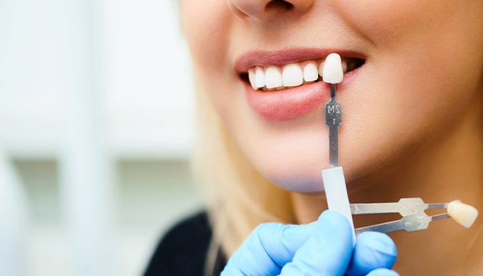 Veneers Prices in Turkey 2023 Veneers Prices in Turkey 2023