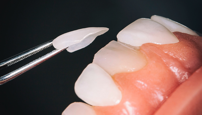 Veneers Prices in Turkey 2023 Veneers Prices in Turkey 2023