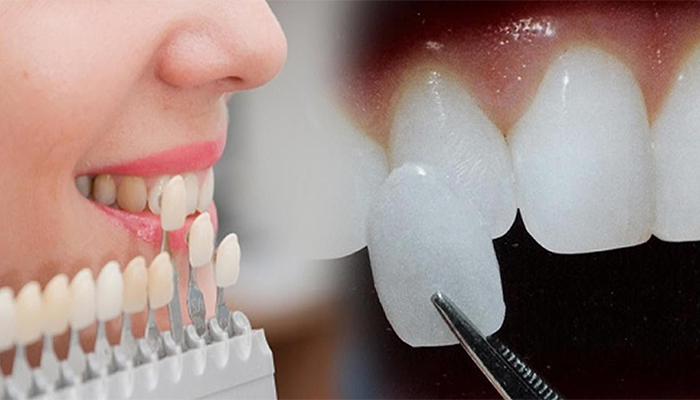 Veneers Prices in Turkey 2023 Veneers Prices in Turkey 2023