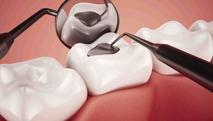 Dental Tooth Filling Prices in Turkey 2023 Dental Tooth Filling Prices in Turkey 2023