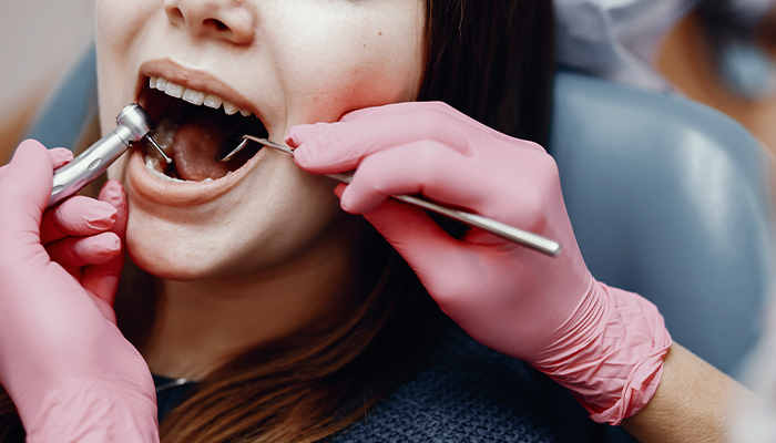 Dental Tooth Filling Prices in Turkey 2023 Dental Tooth Filling Prices in Turkey 2023